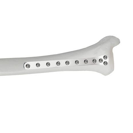 Kompressionsplatte für Tibia - 37.804.0 series - Medicalex - distal / mit Verriegelung / Metall