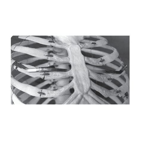 Rippenprothese zur Behandlung des Thorax-Insuffiziens-Syndroms - 37.702 series - Medicalex