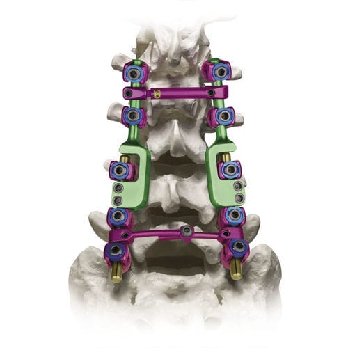 Stabilisierungssystem für Osteosynthese / Lumbal-Sakral - REVERE® ADDITION® - Globus Medical - dorsaler Zugang / für Erwachsene