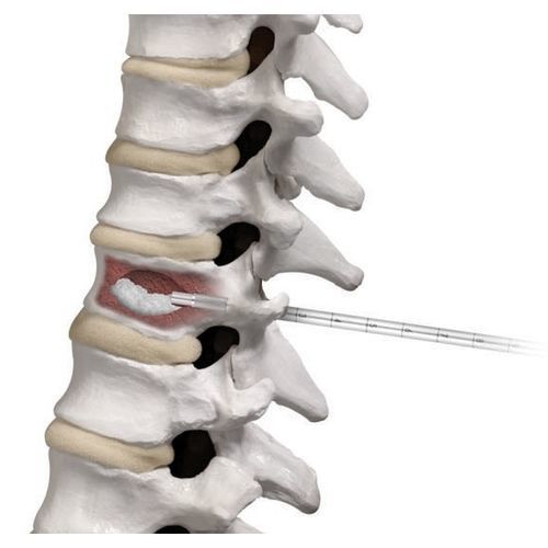 Vertebroplastie-System / Nadel - AFFIRM® - Globus Medical - für perkutane Vertebroplastie