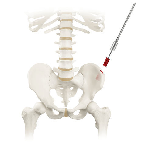 Knochenmarkbiopsienadel - RETRIEVE® - Globus Medical