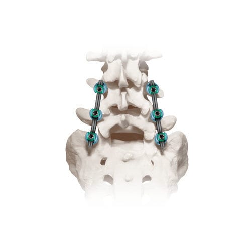 Stabilisierungssystem für Osteosynthese / Lumbal-Sakral - CREO® 5.5  - Globus Medical - dorsaler Zugang / für Erwachsene