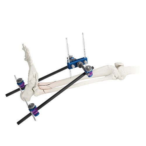 Fixateur externe / für Knöchel - ARBOR® - Globus Medical - rohrförmig / für Erwachsene