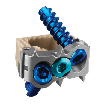 HWS-Zwischenwirbelimplantat - COALITION® - Globus Medical - ventraler Zugang / mit Zervikalknochenplatte