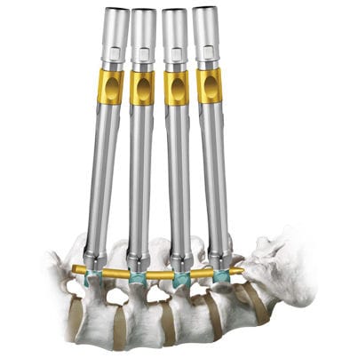 Minimalinvasives Pedikelschrauben-Positionierungssystem - REVOLVE® - Globus Medical