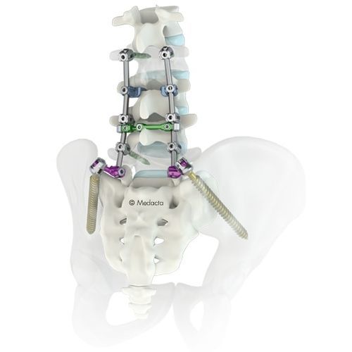 Stabilisierungssystem für Osteosynthese / Lumbal-Sakral - M.U.S.T.® - Medacta - dorsaler Zugang / für Erwachsene