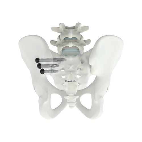 Ilio-sakrales Stabilisierungssystem für Osteosynthese - M.U.S.T.® SI - Medacta - dorsaler Zugang / für Erwachsene