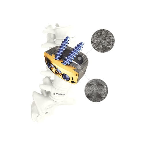LWS-Zwischenwirbelimplantat - MectaLIF® - Medacta - ventraler Zugang / dorsaler Zugang / aus PEEK