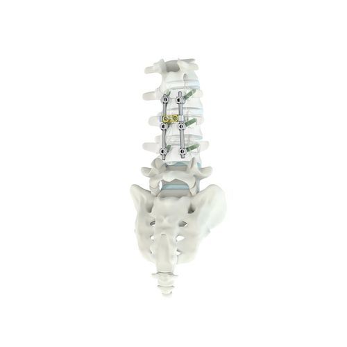 Thorako-lumbales Stabilisierungssystem für Osteosynthese - M.U.S.T.® MC - Medacta - dorsaler Zugang / für Erwachsene