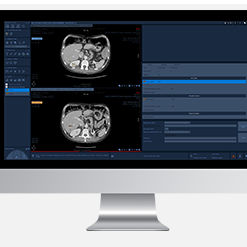 Software-Modul / Onkologie - Myrian® XL-Onco - Intrasense - medizinisch / Computertomographie / Analyse