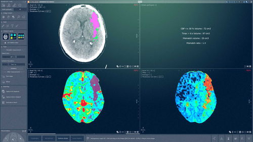 Software-Modul / Computertomographie - MYRIAN® XP-BRAIN - Intrasense - Neurologie / Analyse / Management