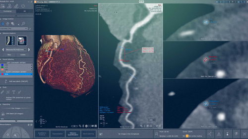 Software-Modul / Kardiologie - Myrian® XP-Cardiac - Intrasense - medizinisch / Analyse / Visualisierung