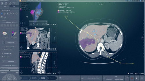 Software-Modul / Analyse - Myrian® XP-Liver - Intrasense - Planung / 3D-Simulation / Röntgen