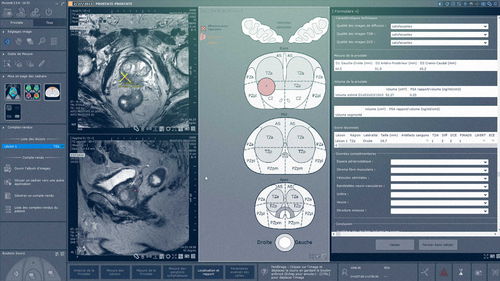 Software-Modul / Analyse - Myrian® XP-Prostate - Intrasense - Visualisierung / MRT / für Ultraschalluntersuchungen