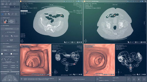 Software-Modul / Onkologie - Myrian® XP-Colon - Intrasense - für Endoskopie / Analyse / Visualisierung