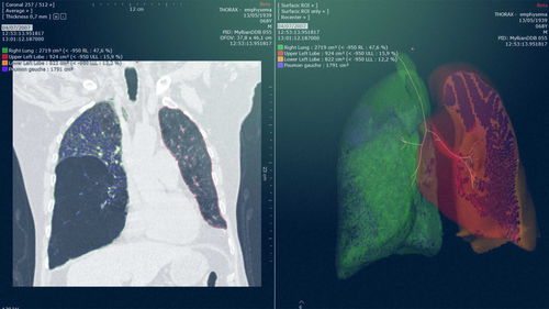 Software-Modul / Analyse - Myrian® XP-Lung - Intrasense - Planung / Simulation / für Radiologie