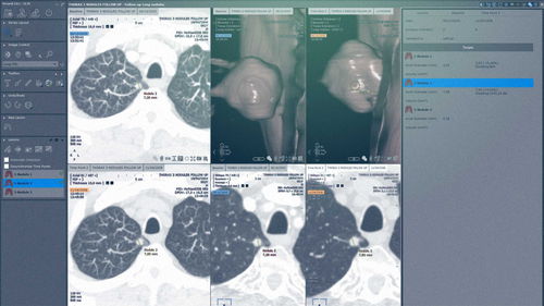 Software-Modul / für Chirurgie - MYRIAN®XP-LUNG NODULE - Intrasense - Analyse / Visualisierung / Bewertung