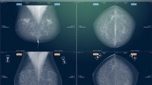 Software-Modul / Analyse - Myrian® XP-Mammo - Intrasense - Visualisierung / medizinisch / für Mammographie