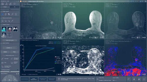 Medizinisches Software-Modul - Myrian® XP-Breast - Intrasense - für Mammographie / Analyse / Visualisierung