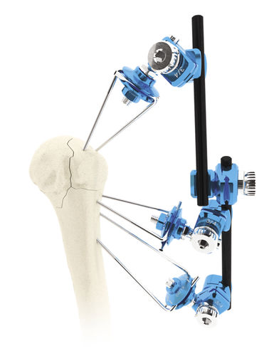 Fixateur externe / für Humerus - CLICKIT - MIKAI - rohrförmig / für Erwachsene
