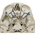 maßgefertigter subperiostales Implantat