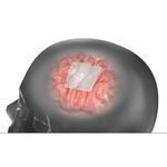 Dura Mater Substitutions-Prothese / Achillessehne der Rinder