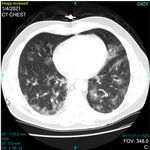 Software für Covid-19-Diagnose