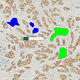 Software-Modul / Onkologie / Immunohistochimie / für fluoreszierende in situ Hybridisierung / Visualisierung