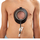 Saugglocke zur Korrektur des Pectus excavatum