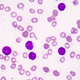 Testkit von akuter lymphoblastischer Leukämie / Onkologie / für Präzisionsmedizin / Gene