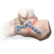 Kompressionsplatte für Calcaneum