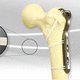 Cerclagekabel für Hüftprothesen-Revision / Multifilament-Polymer