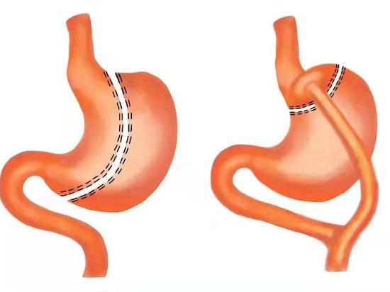 Magenhülse Bariatrische Chirurgie