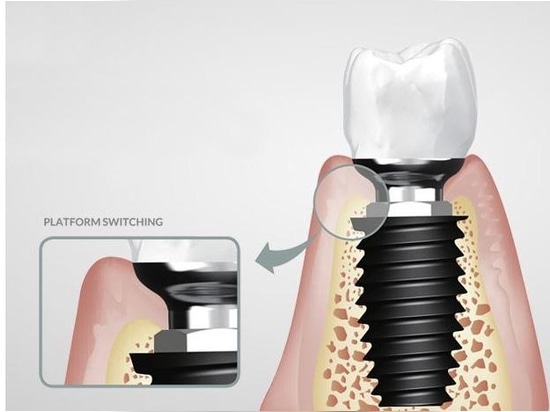 Die Korea Dental Implant (KDI) Inc. stellte ihr SLOCK-Implantatsystem vor.