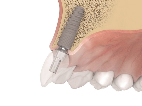 Das tioLogic TWINFIT von Dentaurum