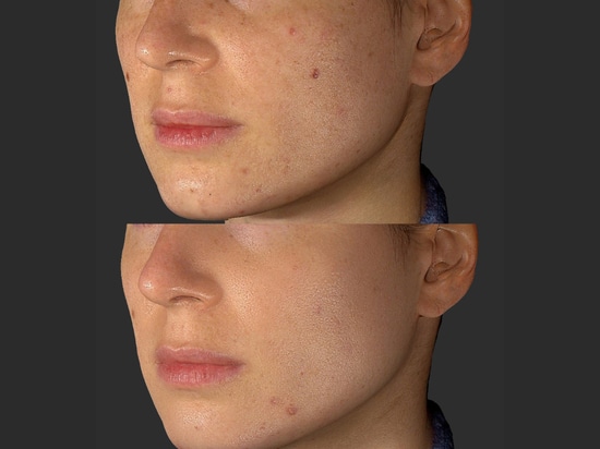 Die Hochzeitssaison ist eröffnet: Eine strahlende Braut und eine unvergessliche Hochzeit mit Quanta's Laser Skincare!