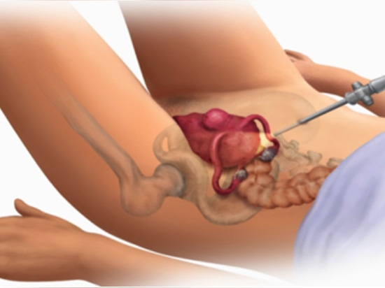 "Unsichtbarer Wächter" der laparoskopischen Totalhysterektomie: Microcure Intelligentes Insufflator-System