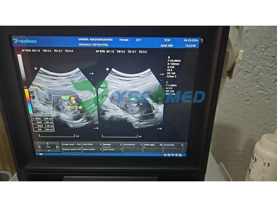 Der tragbare Farbdoppler-Ultraschall YSB-M5 von YSENMED hat sich in einem simbabwischen Krankenhaus bewährt.