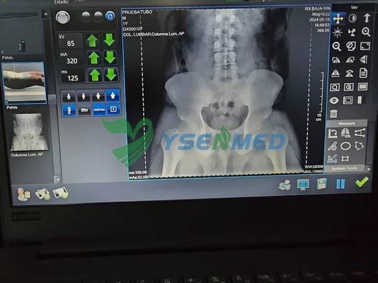 Mexikanischer Radiologe ist zufrieden mit YSENMEDs tragbarem digitalen Röntgensystem YSX056-PE