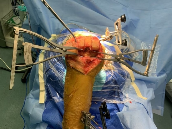 Shandong LiangMed Medical Gap Balancing Spreader mit kreisförmigen Pad oder quadratischen Pad