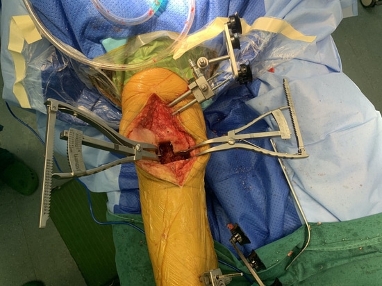 Shandong LiangMed Medical Gap Balancing Spreader mit kreisförmigen Pad oder quadratischen Pad