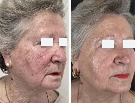 REVYPEEL®: Die nächste Generation der nadelfreien Bio-Revitalisierung