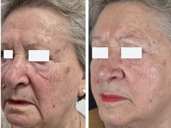 REVYPEEL®: Die nächste Generation der nadelfreien Bio-Revitalisierung
