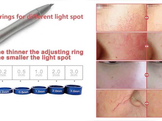 980nm Diodenlaser Funktionsprinzip und Einführung