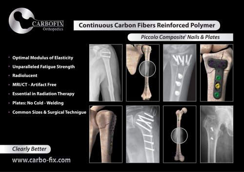 CarboFix Distal Femur Plates