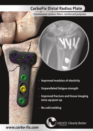 CarboFix Distal Radius Plate