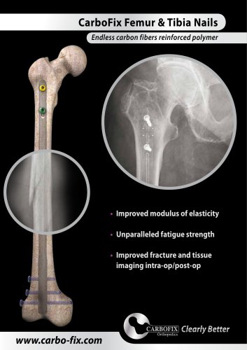 CarboFix Femur & Tibia Nails