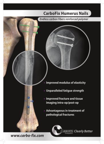 CarboFix Humerus Nails