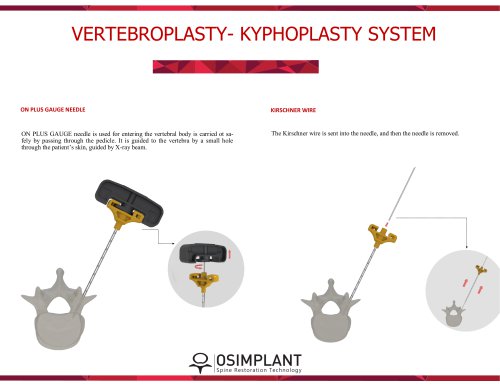 Vertebroplasty- Kyphoplasty Surgical Technique