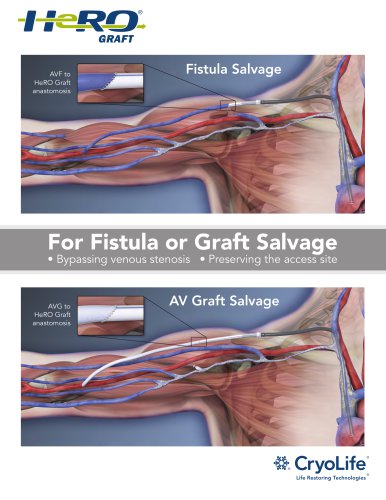 For Fistula or Graft Salvage Bypassing venous stenosis